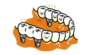 インプラント治療：歯が数本抜けた場合