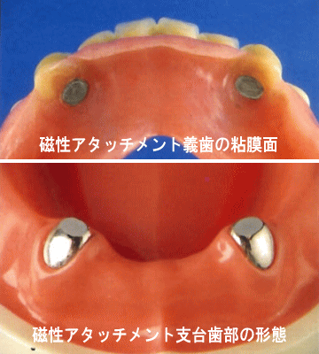 側方の力が働いた時の支台歯への力の伝達の違い