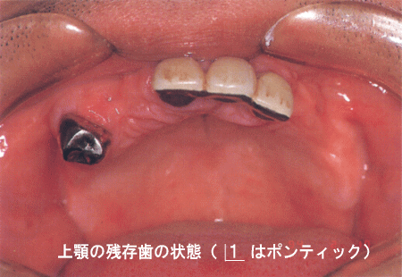 (1)治療前の上顎の状態（残存歯）