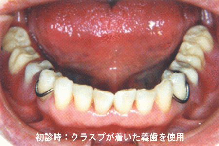 (1)初診時：クラスプが着いた義歯を使用