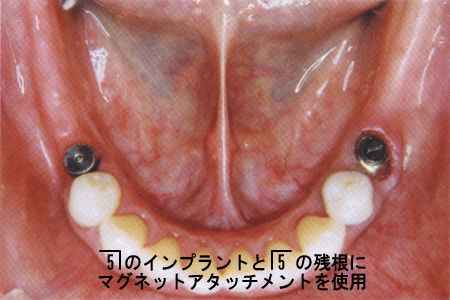 (2)右5インプラントと左5残根歯にマグネットアタッチメントを使用