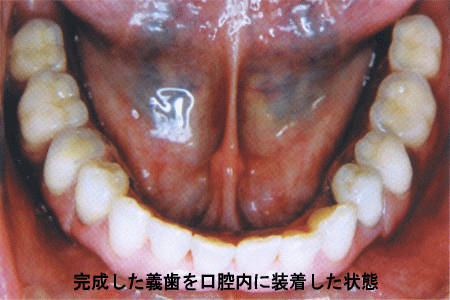 (4)完成した義歯を口腔内に装着した状態